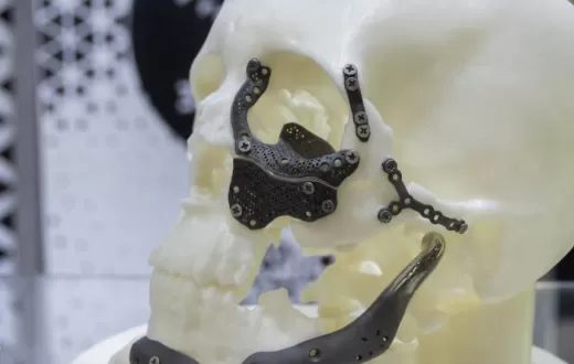 全球首款！可在医院内即时3D打印的钛合金植入物获批