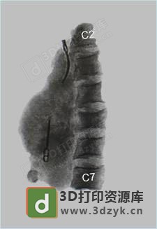 长征医院用3D打印将患者全颈椎椎体换为钛合金 (3).jpg