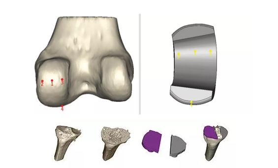 膝关节置换术中，如何让患者定制化植入体设计更简单？ (3).png