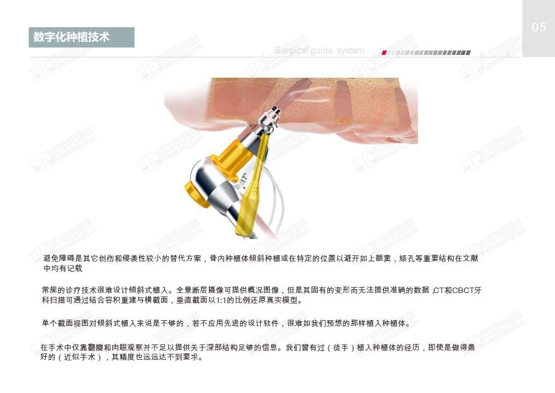 牙科数字化种植导板流程与临床应用 (6).JPG