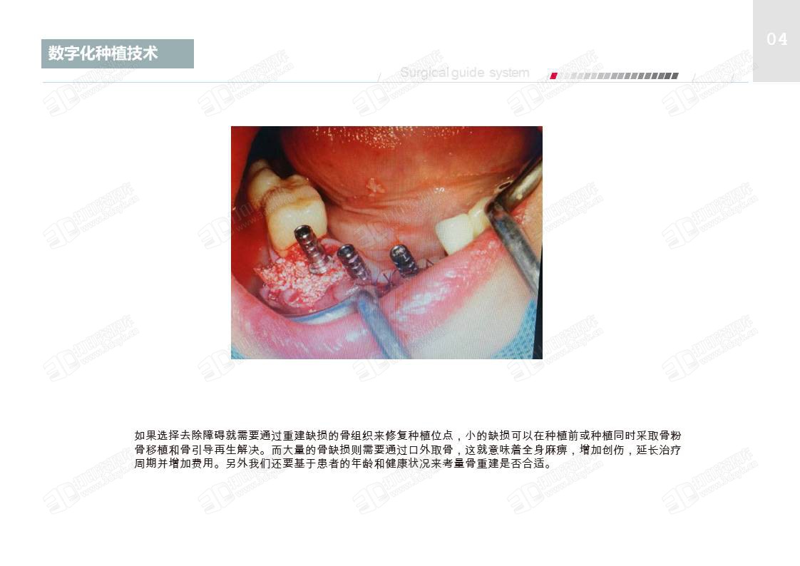 牙科数字化种植导板流程与临床应用 (5).JPG