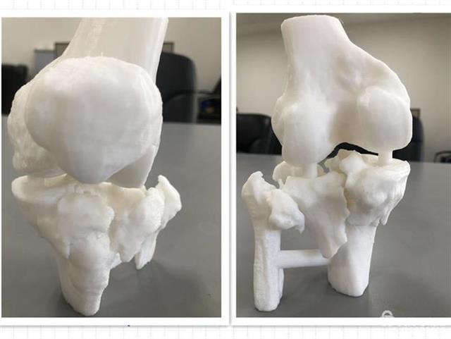 协和江南医院利用3D打印技术，成功为胫骨骨折患者实施手术 (2).jpeg