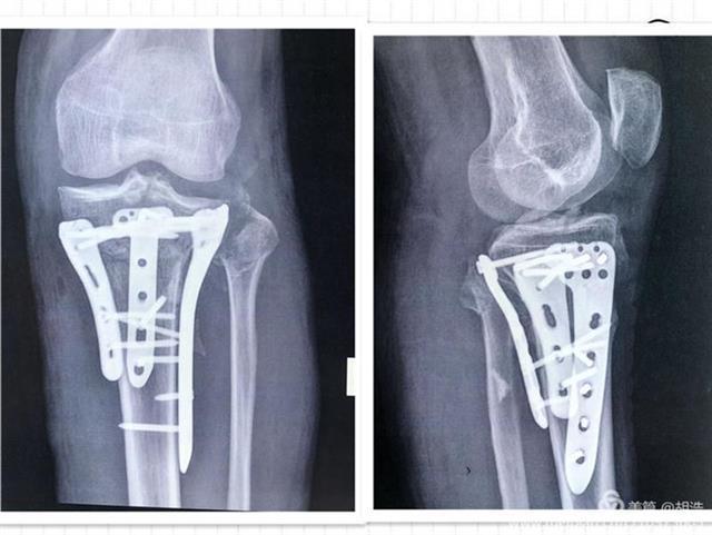 协和江南医院利用3D打印技术，成功为胫骨骨折患者实施手术 (3).jpeg