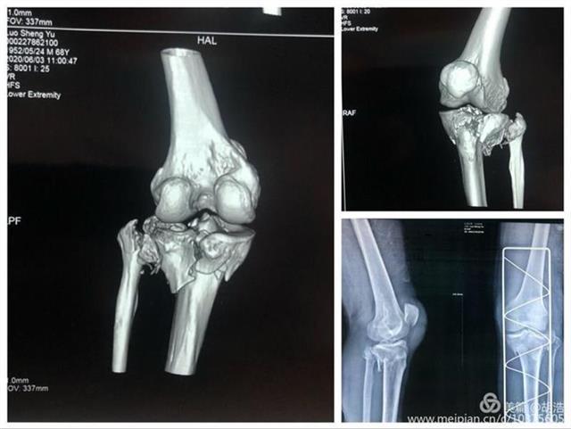 协和江南医院利用3D打印技术，成功为胫骨骨折患者实施手术 (1).jpeg