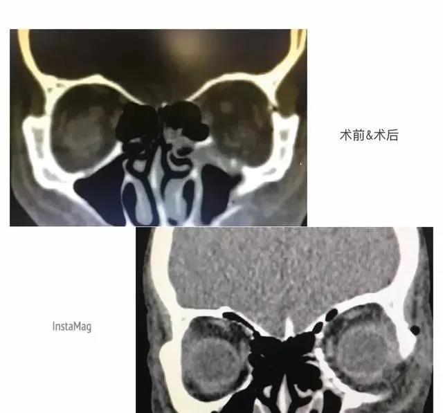 3D打印技术首次在眼科手术中实现应用，1：1还原！ (2).jpg