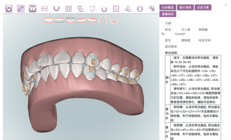 且看美立刻如何把3D打印引入到口腔正畸领域 (2).png